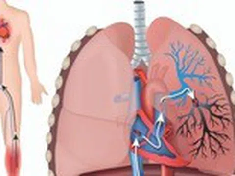 Cẩn thận bệnh 'sát thủ ẩn mình' thuyên tắc động mạch phổi gây tử vong nhanh trong 1-2 giờ