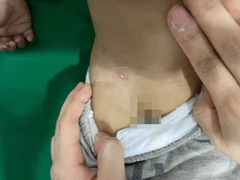 Vết đốt gây nguy hiểm cho bé 15 tháng tuổi