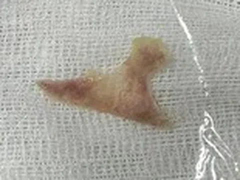 Trẻ hóc xương gà đâm xuyên thành thực quản 3 ngày mới phát hiện
