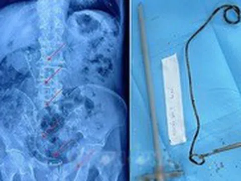 Ống sonde hơn 20cm 'ngủ quên' trong thận - bàng quang cụ ông 82 tuổi