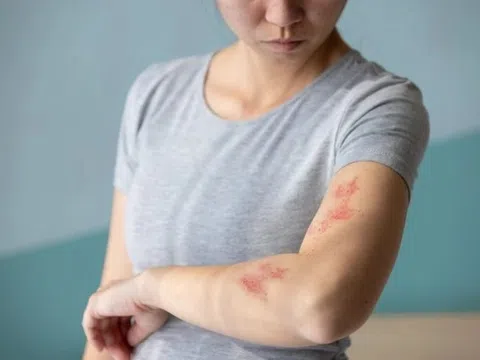 Giời leo là bệnh gì?