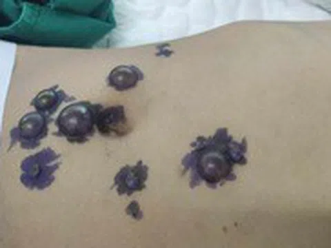 Cứu sống bé trai bị bệnh hiếm chưa từng ghi nhận trên y văn Việt Nam