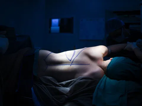 Cảnh bác sĩ 'biến hóa' cơ lưng làm ngực cho nữ bệnh nhân