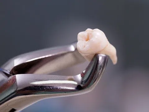 Phải đi cấp cứu chỉ vì nhổ răng khôn