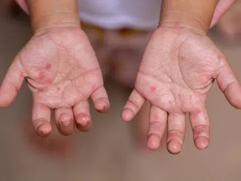 Đồng Nai lo ngại bệnh truyền nhiễm quay lại do thiếu vaccine