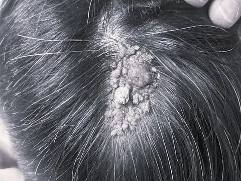 Từ vết bớt nhỏ trên đầu thành khối ung thư ác tính