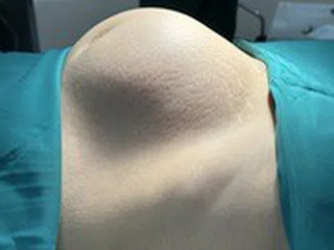 Khối u xơ tử cung 'khủng', người phụ nữ tưởng bị béo phì