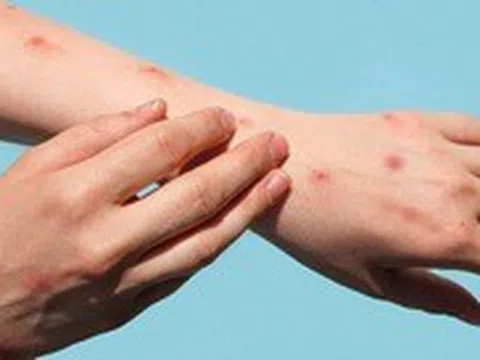 Tổ chức Y tế thế giới họp khẩn vì bệnh đậu mùa khỉ