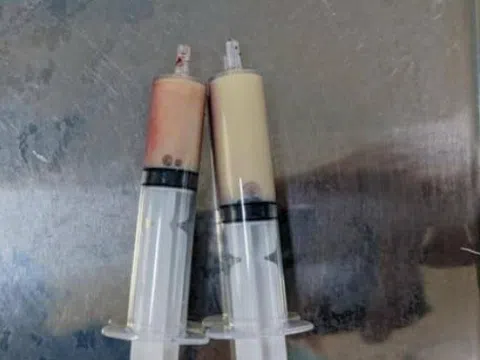 Người đàn ông đi cấp cứu với cơn đau bụng dữ dội