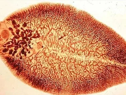 Ho ra máu cảnh giác với sán lá phổi
