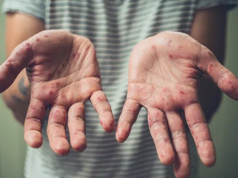 Chủng virus đậu mùa khỉ dễ lây hơn đã lan đến châu Âu