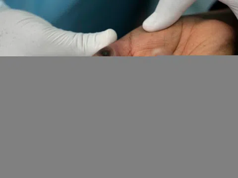 Đợt bùng phát đậu mùa khỉ gợi nhớ ngày đầu của 'bóng ma' HIV