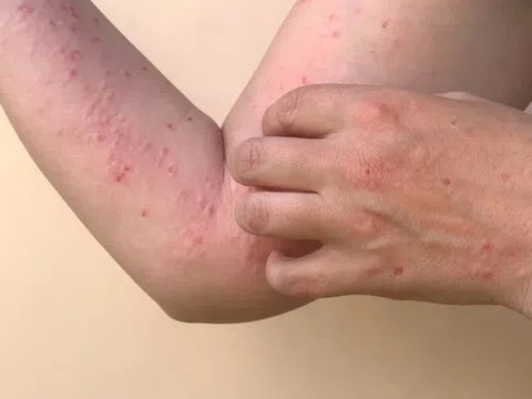 Triệu chứng điển hình của đậu mùa khỉ