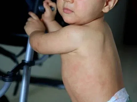 Những dấu hiệu sớm của sởi không nên bỏ qua