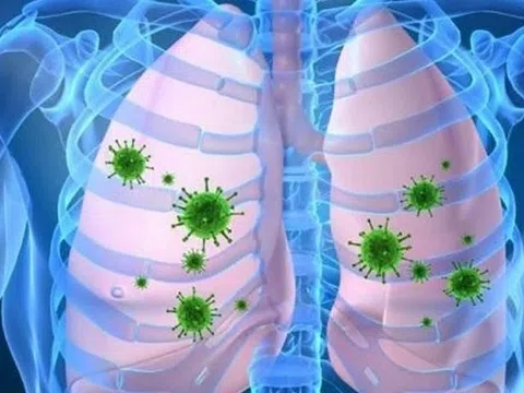 Viêm phổi do phế cầu chữa như thế nào?