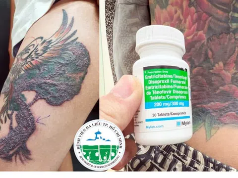 Nhập viện vì biến chứng do xăm hình