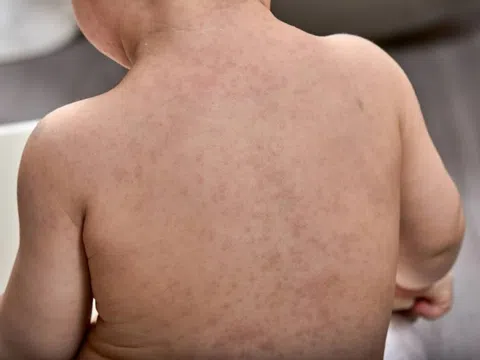 Dấu hiệu dễ nhầm lẫn giữa sởi và sốt phát ban