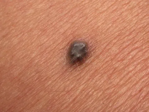 Vì sao nốt ruồi có thể là dấu hiệu của bệnh ung thư nguy hiểm