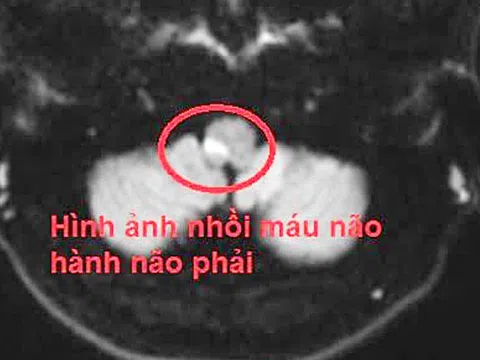 Tưởng chóng mặt do say rượu, không ngờ bị đột quỵ não