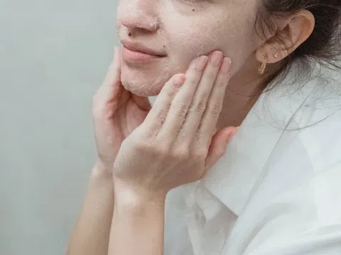 Dùng các sản phẩm trị mụn trứng cá cần lưu ý gì?