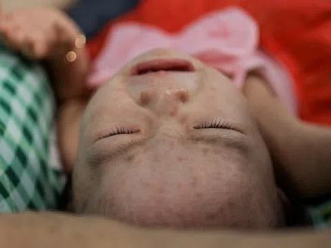 TP.HCM tiêm vaccine sởi cho tất cả trẻ em từ 31/8