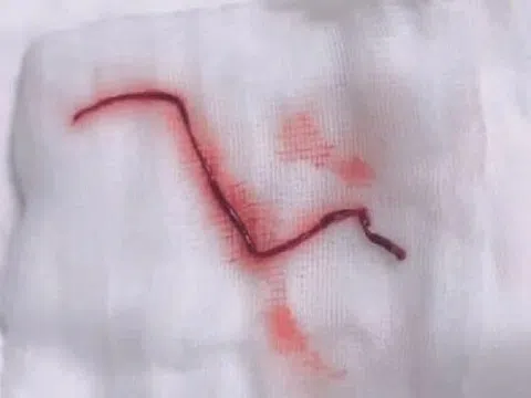 Lấy được cục máu đông gây đột quỵ dài chưa từng thấy