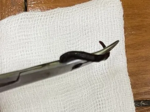 Bé gái liên tục sụt cân, đi khám bác sĩ gắp ra sinh vật sống trong mũi