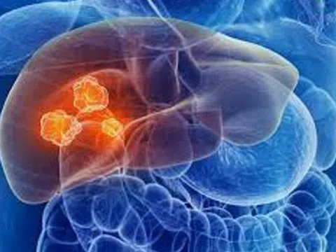 Cẩn trọng thói quen ăn uống khiến gan tổn thương lỗ chỗ