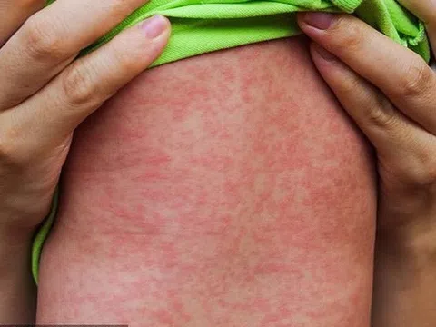 Nhận biết nốt ban do sốt xuất huyết, sốt phát ban và sởi