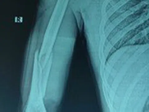 Nam thanh niên tập gym bị gãy xương khi chơi vật tay