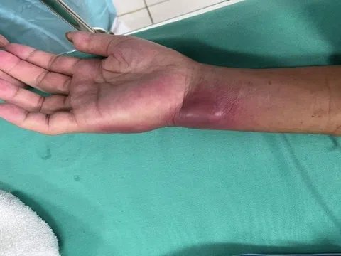 Cổ tay sưng húp, áp xe của bệnh nhân nhiễm vi khuẩn 'ăn thịt người'
