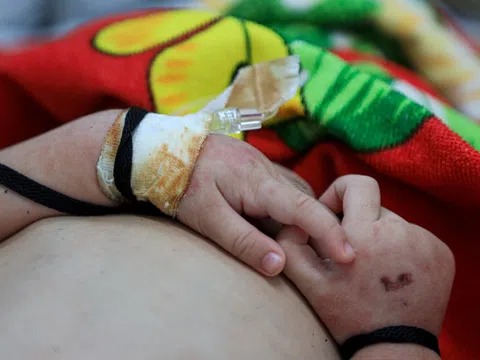 Một dấu hiệu đặc trưng ít được để ý của bệnh sởi