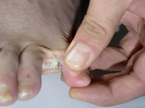 Những bệnh cần lưu ý sau mưa bão