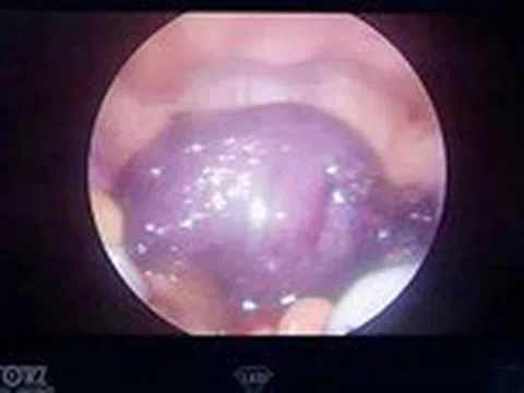 Trẻ đau bụng do u buồng trứng dễ biến chứng vô sinh