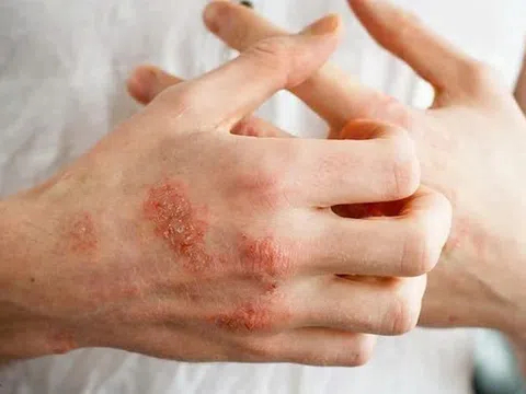 Loạt bệnh về da thường gặp sau mùa mưa lũ, cần biết để tránh biến chứng nguy hiểm