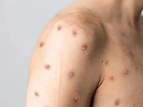 Ai dễ mắc bệnh đậu mùa khỉ?