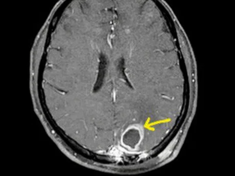 ‘Vi khuẩn ăn thịt người’ tấn công não người bệnh