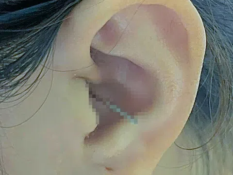 Chồng bất ngờ ôm vợ trong lúc vợ đang ngoáy tai làm dị vật đâm sâu vào tai trái