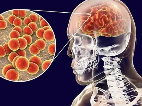 6 bệnh viêm màng não, viêm não thường gặp