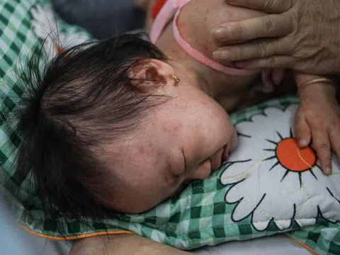 Bé 9 tuổi nguy kịch sau vài ngày sốt phát ban
