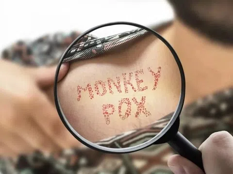 Dấu hiệu nghi ngờ đang mắc đậu mùa khỉ