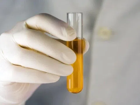 Nước tiểu sẫm màu do nguyên nhân gì?