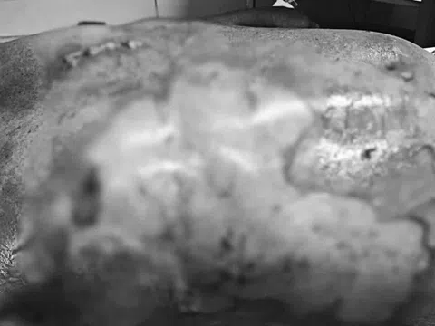 Tai nạn bỏng nặng do thói quen đốt rác