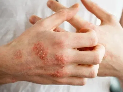 6 lưu ý phòng bệnh da liễu trong mùa mưa