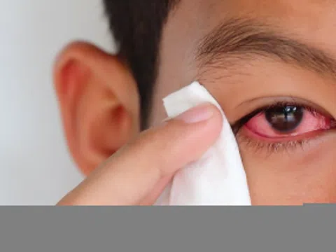 Nhìn vào mắt người bị đau mắt đỏ có lây không?