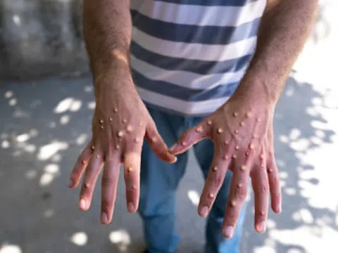 4 biện pháp phòng bệnh đậu mùa khỉ