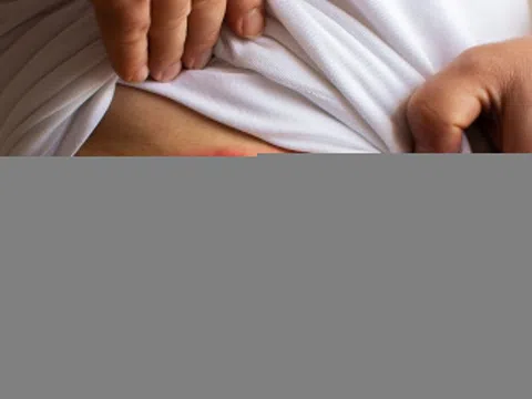 Dấu hiệu đặc trưng của giời leo