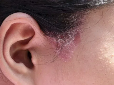 Bệnh nấm da đầu có lây qua tiếp xúc?