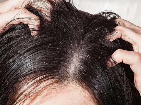 Lựa chọn dầu gội khi bị nấm da đầu