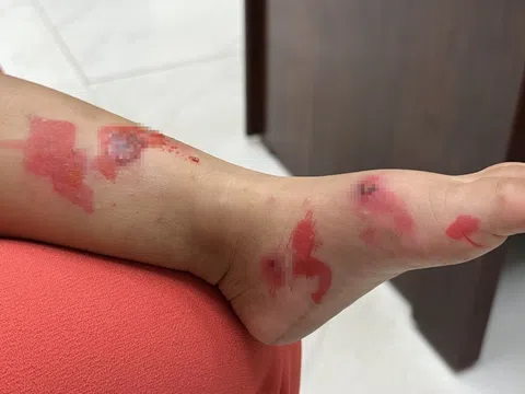 Các bệnh nhiễm trùng da phổ biến